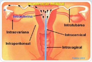 img-inseminacao-artificial