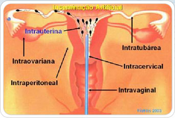 inseminação artificial