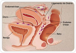 img-endometriose